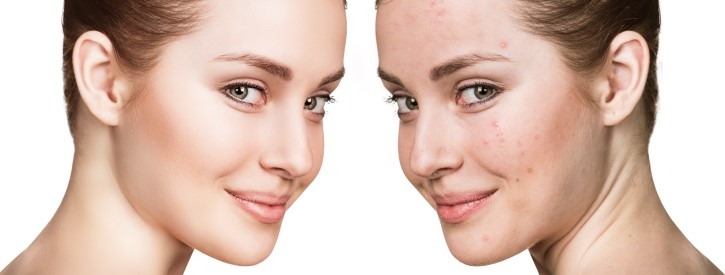 La piel en tiempos de confinamiento: dermatitis seborreica